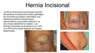 Hernia Incisional
• la hernia incisional es la protrusión anormal
del peritoneo a través de la cicatriz patológica
de una herida quirúrgica o traumática, que
interesa los planos músculo-fascio-
aponeuróticos y que puede contener o no
una víscera abdominal y/o tejidos.. Las
hernias incisionales se producen en un 10%
a un 23% de los casos después de cirugías
abdominales.
 
