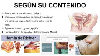 SEGÚN SU CONTENIDO
 Enterocele: hernia del intestino delgado.
 (Enterocele parcial o hérnia de Richter): cuando sólo
una porción de la pared del intestino está dentro del
saco.
 Epiplocele: intestino grueso, epiplón.
 Hernia de Littrer: del apéndice, del divertículo de Meckel
 