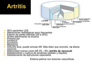  90% pacientes LES
 Alteraciones radiológicas poco frecuentes
 Edema de partes blandas (20 a 25%)
 Artritis deformante no erosiva
 Poliarticular
 Simétrica
 Episódica
 Migratoria
 Sinovitis leve, puede simular AR. Más dolor que sinovitis, no afecta
columna
 Deformidad manos como AR 3% - 8% (artritis de Jaccoud)
 Debilitamiento y ruptura de tendones (patelar y Aquiles)
 Debilitamiento de estructuras capsulares
Eritema palmar con lesiones vasculíticas
 