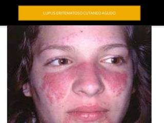 LUPUS ERITEMATOSOCUTANEO AGUDO
 