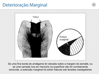 59
Se uma fina borda de amálgama for deixada sobre a margem de esmalte, ou
se uma camada rica em mercúrio na superfície não for corretamente
removida, a extensão marginal irá sofrer fraturas sob tensões mastigatórias
 