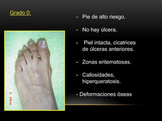 Grado 0:
- Pie de alto riesgo.
- No hay úlcera.
- Piel intacta, cicatrices
de úlceras anteriores.
- Zonas eritematosas.
- Callosidades,
hiperqueratosis.
- Deformaciones óseas
 