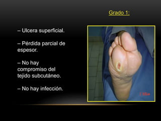 Grado 1:
– Ulcera superficial.
– Pérdida parcial de
espesor.
– No hay
compromiso del
tejido subcutáneo.
– No hay infección.
 
