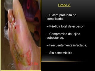 Grado 2:
– Ulcera profunda no
complicada.
– Pérdida total de espesor.
– Compromiso de tejido
subcutáneo.
– Frecuentemente infectada.
– Sin osteomielitis
 