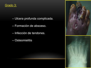 Grado 3:
– Ulcera profunda complicada.
– Formación de absceso.
– Infección de tendones.
– Osteomielitis
 