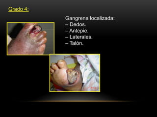 Grado 4:
Gangrena localizada:
– Dedos.
– Antepie.
– Laterales.
– Talón.
 