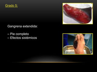 Grado 5:
Gangrena extendida:
– Pie completo
– Efectos sistémicos
 