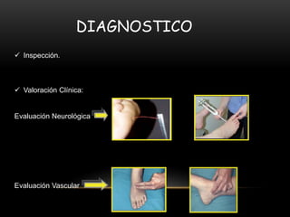 DIAGNOSTICO
 Inspección.
 Valoración Clínica:
Evaluación Neurológica
Evaluación Vascular
 