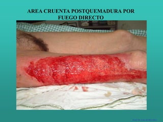 AREA CRUENTA POSTQUEMADURA POR
FUEGO DIRECTO
Prof. Dr. Luis del Rio Diez
 