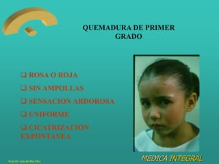 MEDICA INTEGRAL
QUEMADURA DE PRIMER
GRADO
 ROSA O ROJA
 SIN AMPOLLAS
 SENSACION ARDOROSA
 UNIFORME
 CICATRIZACION
EXP...