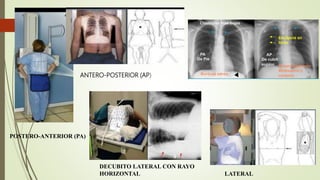 POSTERO-ANTERIOR (PA)
ANTERO-POSTERIOR (AP)
LATERAL
DECUBITO LATERAL CON RAYO
HORIZONTAL
 