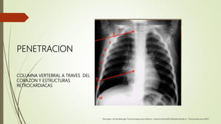 PENETRACION
COLUMNA VERTEBRAL A TRAVES DEL
CORAZON Y ESTRUCTURAS
RETROCARDIACAS
 