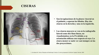 CISURAS
• Son invaginaciones de la pleura visceral en
el pulmón y separan los lóbulos. Hay dos
cisuras en la derecha y una en la izquierda.
• Las cisuras mayores se ven en la radiografía
lateral como dos finas líneas, no
visualizándose en la PA debido a su
orientación oblicua con respecto al rayo. La
cisura menor se suele ver casi siempre en las
dos proyecciones.
 