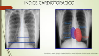 INDICE CARDIOTORACICO
 