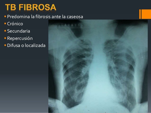 Tuberculosis Pulmonar diagóstico Imagenológico
