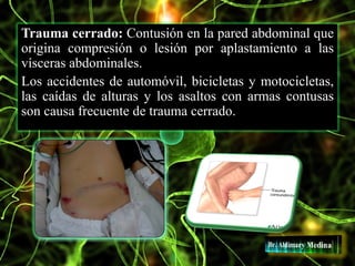 Trauma cerrado: Contusión en la pared abdominal que
origina compresión o lesión por aplastamiento a las
vísceras abdominales.
Los accidentes de automóvil, bicicletas y motocicletas,
las caídas de alturas y los asaltos con armas contusas
son causa frecuente de trauma cerrado.
 