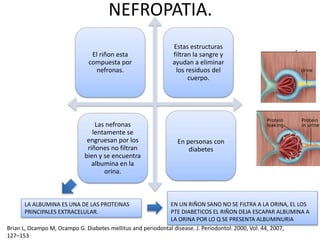 NEFROPATIA.
El riñon esta
compuesta por
nefronas.
Estas estructuras
filtran la sangre y
ayudan a eliminar
los residuos del
cuerpo.
En personas con
diabetes
Las nefronas
lentamente se
engruesan por los
riñones no filtran
bien y se encuentra
albumina en la
orina.
EN UN RIÑON SANO NO SE FILTRA A LA ORINA, EL LOS
PTE DIABETICOS EL RIÑON DEJA ESCAPAR ALBUMINA A
LA ORINA POR LO Q SE PRESENTA ALBUMINURIA
LA ALBUMINA ES UNA DE LAS PROTEINAS
PRINCIPALES EXTRACELULAR.
Brian L, Ocampo M, Ocampo G. Diabetes mellitus and periodontal disease. J. Periodontol. 2000, Vol. 44, 2007,
127–153
 