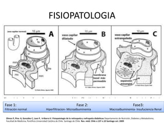FISIOPATOLOGIA
Fase 1: Fase 2: Fase3:
Filtración normal Hiperfiltracion- Microalbuminemia Macroalbuminemia- Insufuciencia Renal
Olmos P, Pino A, González C, Laso P, Irribarra V. Fisiopatología de la retinopatía y nefropatía diabéticas Departamento de Nutrición, Diabetes y Metabolismo,
Facultad de Medicina, Pontificia Universidad Católica de Chile. Santiago de Chile. Rev. méd. Chile v.137 n.10 Santiago oct. 2009
 