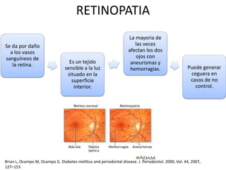 RETINOPATIA
Se da por daño
a los vasos
sanguíneos de
la retina.
Es un tejido
sensible a la luz
situado en la
superficie
interior.
La mayoria de
las veces
afectan los dos
ojos con
aneurismas y
hemorragias. Puede generar
ceguera en
casos de no
control.
Brian L, Ocampo M, Ocampo G. Diabetes mellitus and periodontal disease. J. Periodontol. 2000, Vol. 44, 2007,
127–153
 