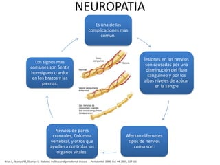 NEUROPATIA
Es una de las
complicaciones mas
común.
lesiones en los nervios
son causadas por una
disminución del flujo
sanguíneo y por los
altos niveles de azúcar
en la sangre
Afectan difernetes
tipos de nervios
como son:
Nervios de pares
craneales, Columna
vertebral, y otros que
ayudan a controlar los
organos vitales.
Los signos mas
comunes son Sentir
hormigueo o ardor
en los brazos y las
piernas.
Brian L, Ocampo M, Ocampo G. Diabetes mellitus and periodontal disease. J. Periodontol. 2000, Vol. 44, 2007, 127–153
 