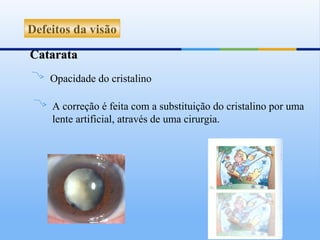 Defeitos da visão

Catarata
    Opacidade do cristalino

    A correção é feita com a substituição do cristalino por uma
    lente artificial, através de uma cirurgia.
 