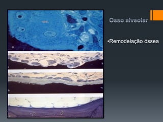 •Remodelação óssea
 