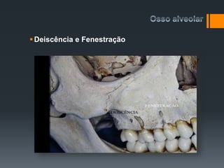 Osso alveolar
Deiscência e Fenestração
 