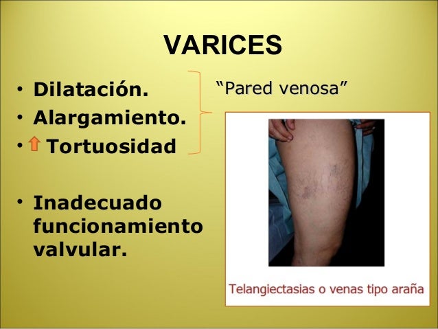 El aumento de las venas en los pies de la causa