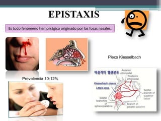 Es todo fenómeno hemorrágico originado por las fosas nasales.
Prevalencia 10-12%
Plexo Kiesselbach
EPISTAXIS
 