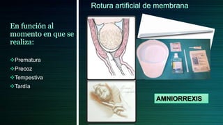 Prematura
Precoz
Tempestiva
Tardía

              AMNIORREXIS
 