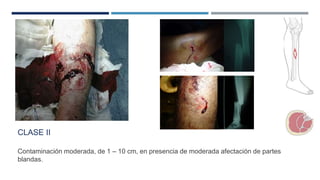 CLASE II 
Contaminación moderada, de 1 – 10 cm, en presencia de moderada afectación de partes 
blandas. 
 