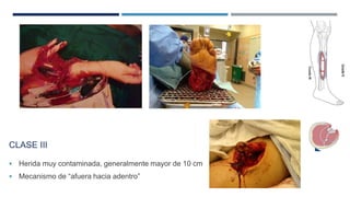 CLASE III 
 Herida muy contaminada, generalmente mayor de 10 cm 
 Mecanismo de “afuera hacia adentro” 
 