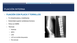 FIJACIÓN INTERNA 
– FIJACIÓN CON PLACA Y TORNILLOS 
– Fx intraarticulares y metafisarias 
– Extremidad superior (antebrazo-húmero) 
– Fémur en SDRA 
– Técnicas 
• Estándar 
• MIPO 
• LISS 
• LCP con tornillos bloqueados 
• Peri-articular 
 