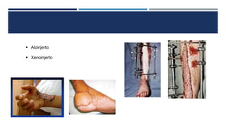  Aloinjerto 
 Xenoinjerto 
 