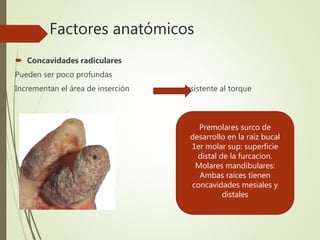 Factores anatómicos
 Concavidades radiculares
Pueden ser poco profundas
Incrementan el área de inserción resistente al torque
Premolares surco de
desarrollo en la raíz bucal
1er molar sup: superficie
distal de la furcacion.
Molares mandibulares:
Ambas raíces tienen
concavidades mesiales y
distales
 
