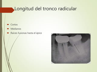 Longitud del tronco radicular
 Cortos
 Medianos
 Raíces fusionas hasta el ápice
 