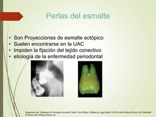 • Son Proyecciones de esmalte ectópico
• Suelen encontrarse en la UAC
• Impiden la fijación del tejido conectivo
• etiología de la enfermedad periodontal
Diagnosis and Treatment of Furcation-Involved Teeth, First Edition. Edited by Luigi Nibali. © 2018 John Wiley & Sons Ltd. Published
2018 by John Wiley & Sons Ltd.
Perlas del esmalte
 