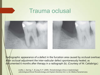 Radiographic appearance of a defect in the furcation area caused by occlusal overload
After occlusal adjustment the inter‐radicular defect spontaneously healed, as
documented 6 months after therapy in a radiograph (b). (Courtesy of M. Cattabriga.)
Lindhe, J., Karring, T., & Lang, N. P. (2009). Periodontologia clinica e implantologia
odontologica/Clinical Periodontology and Implant Dentistry (Vol. 1). Ed. Médica Panamericana.
Trauma oclusal
 
