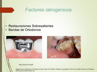 • Restauraciones Sobresalientes
• Bandas de Ortodoncia
http://bit.ly/2x7iqGF
Diagnosis and Treatment of Furcation-Involved Teeth, First Edition. Edited by Luigi Nibali. © 2018 John Wiley & Sons Ltd. Published
2018 by John Wiley & Sons Ltd.
Factores iatrogenicos
 