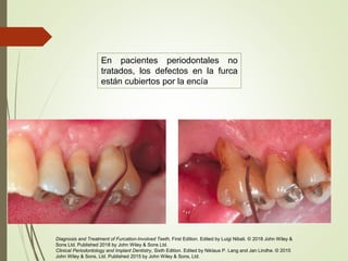 En pacientes periodontales no
tratados, los defectos en la furca
están cubiertos por la encía
Diagnosis and Treatment of Furcation-Involved Teeth, First Edition. Edited by Luigi Nibali. © 2018 John Wiley &
Sons Ltd. Published 2018 by John Wiley & Sons Ltd.
Clinical Periodontology and Implant Dentistry, Sixth Edition. Edited by Niklaus P. Lang and Jan Lindhe. © 2015
John Wiley & Sons, Ltd. Published 2015 by John Wiley & Sons, Ltd.
 