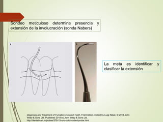 Sondeo meticuloso determina presencia y
extensión de la involucración (sonda Nabers)
La meta es identificar y
clasificar la extensión
Diagnosis and Treatment of Furcation-Involved Teeth, First Edition. Edited by Luigi Nibali. © 2018 John
Wiley & Sons Ltd. Published 2018 by John Wiley & Sons Ltd.
http://dentalmart.in/probes/378-15-unc-color-coded-probe.html
 