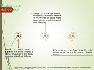 1.
- Colocar la sonda sobre la
superficie del diente coronal al
margen gingival en el sitio donde
se espera una entrada de furca
2.
- Empujar la sonda apicalmente,
desplazando suavemente la encía
en movimientos en zigzag hasta
que se alcanza la parte inferior del
surco o la bolsa
3.
- Si la sonda cae en un hoyo horizontal, en la
mayoría de los casos se ha detectado defecto
en furca
Diagnosis and Treatment of Furcation-Involved Teeth, First Edition. Edited by Luigi Nibali. © 2018 John Wiley & Sons Ltd. Published
2018 by John Wiley & Sons Ltd.
Paso a paso
del sondaje
 