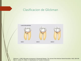 Clasificacion de Glickman
Glickman, I. (1950). Bifurcation Involvement in Periodontal Disease. The Journal of the American Dental Association, 40(5), 528–538.
Mani, A., James, R., & Mani, S. Classifications for Furcation Involvement.
 
