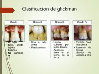 Clasificacion de glickman
 
