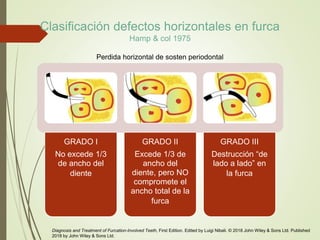 Clasificación defectos horizontales en furca
Hamp & col 1975
Perdida horizontal de sosten periodontal
GRADO I
No excede 1/3
de ancho del
diente
GRADO II
Excede 1/3 de
ancho del
diente, pero NO
compromete el
ancho total de la
furca
GRADO III
Destrucción “de
lado a lado” en
la furca
Diagnosis and Treatment of Furcation-Involved Teeth, First Edition. Edited by Luigi Nibali. © 2018 John Wiley & Sons Ltd. Published
2018 by John Wiley & Sons Ltd.
 