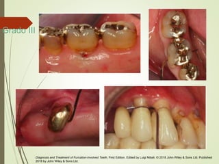 Grado III
Diagnosis and Treatment of Furcation-Involved Teeth, First Edition. Edited by Luigi Nibali. © 2018 John Wiley & Sons Ltd. Published
2018 by John Wiley & Sons Ltd.
 