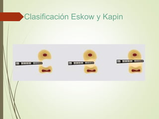 Clasificación Eskow y Kapin
 