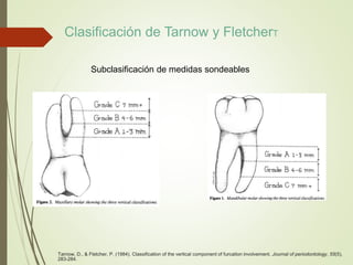 Subclasificación de medidas sondeables
Tarnow, D., & Fletcher, P. (1984). Classification of the vertical component of furcation involvement. Journal of periodontology, 55(5),
283-284.
Clasificación de Tarnow y FletcherT
 