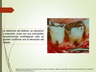 La detección del defecto, su ubicación
y extensión, junto con sus principales
características morfológicas solo se
pueden confirmar con la elevación del
colgajo
Diagnosis and Treatment of Furcation-Involved Teeth, First Edition. Edited by Luigi Nibali. © 2018 John Wiley & Sons Ltd. Published
2018 by John Wiley & Sons Ltd.
 