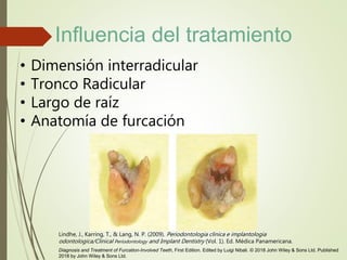 • Dimensión interradicular
• Tronco Radicular
• Largo de raíz
• Anatomía de furcación
Lindhe, J., Karring, T., & Lang, N. P. (2009). Periodontologia clinica e implantologia
odontologica/Clinical Periodontology and Implant Dentistry (Vol. 1). Ed. Médica Panamericana.
Diagnosis and Treatment of Furcation-Involved Teeth, First Edition. Edited by Luigi Nibali. © 2018 John Wiley & Sons Ltd. Published
2018 by John Wiley & Sons Ltd.
Influencia del tratamiento
 